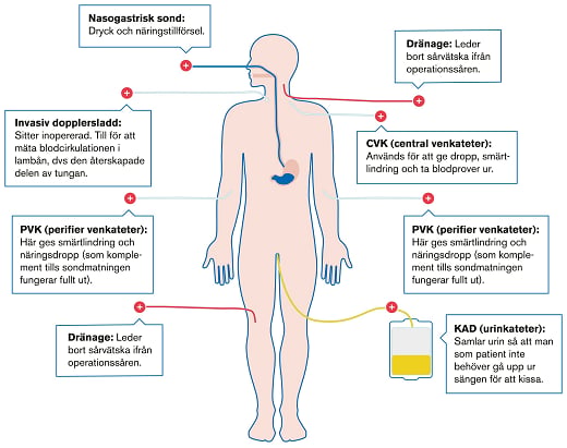 Diagram över slangar kopplade till kroppen efter operation